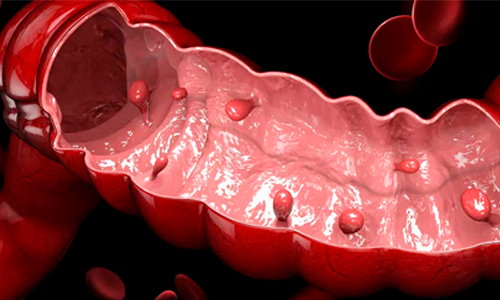 Pólipos Intestinais